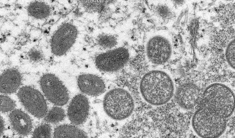 Monkeypox: Is it deadly? Is it easy to catch?